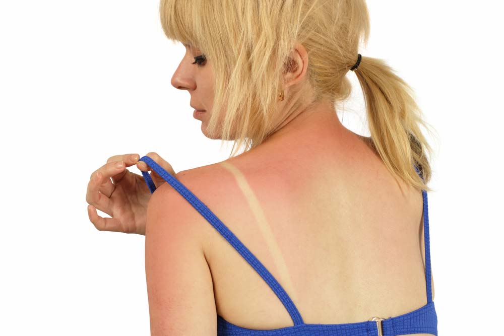 Sunburn Prevention and Relief